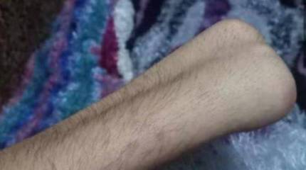 На Украине признали годным к воинской службе инвалида без кисти руки