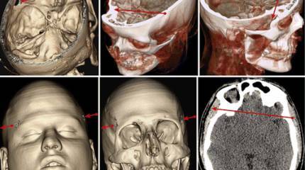 В американском медицинском журнале вышла статья, в которой говорится о "реальных причинах победы Кутузова над Наполеоном в 1812 году"